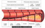 L'<b>aterosclerosi</b> è una malattia