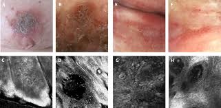 Attēlu rezultāti vaicājumam “Diderma simplex”