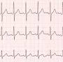 search Ventricular tachycardia from my.clevelandclinic.org
