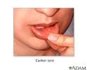 Saint Thomas Health - Health Information - Canker sore