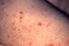 <b>syphilis</b> skin rash