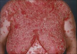 Attēlu rezultāti vaicājumam “Pemphigus borealis”