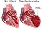 Dilated Cardiomyopathy Genetic Testing