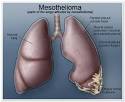 <b>Mesothelioma</b> Cancer