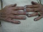<b>Cyanosis</b>: Bluish discoloration