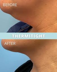 Image result for rupaljanuj