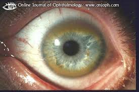 Kuvahaun tulos haulle Kayser-Fleischer