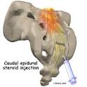 Preferred Pain Center Blog: Review of Caudal Epidural Injections ...