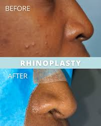 Image result for rupaljanuj