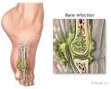 <b>Osteomyelitis</b>