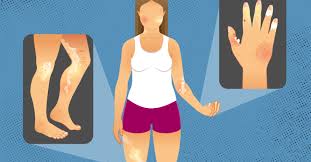 Attēlu rezultāti vaicājumam “Scleroderma”