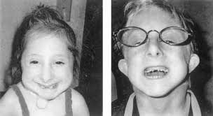 Image result for Nanismo Primordial