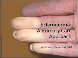 Attēlu rezultāti vaicājumam “Scleroderma”