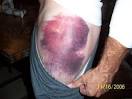 Small <b>hematomas</b> may resolve in