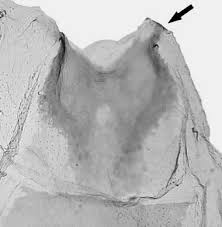Attēlu rezultāti vaicājumam “Scardia boletella exuvia”