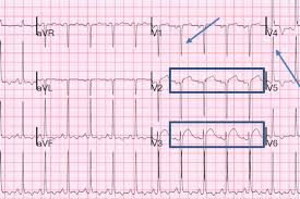 Image result for  ^ L V [ h    