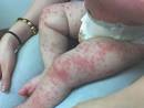 KAWASAKI DISEASE | medicaltrue.