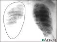 Aortic rupture, chest x-ray: MedlinePlus Medical Encyclopedia Image