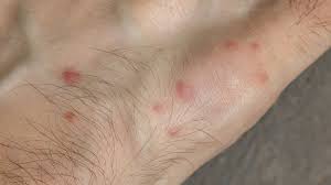 Image result for bed bug bites