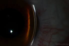 Kuvahaun tulos haulle Kayser-Fleischer