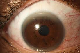 Kuvahaun tulos haulle Kayser-Fleischer