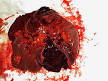 <b>Splenectomy</b>
