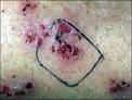 Morgellons Disease Pictures