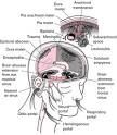 cerebral meningitis - definition of cerebral meningitis in the ...