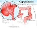 <b>Appendicitis</b> Causes, Symptoms, Treatment - <b>Appendicitis</b> Causes on