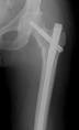 Hip Fractures - OrthoInfo - AAOS