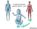 X-linked recessive genetic defects - how boys are affected