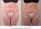 Exilis Uses Monopolar Radio Frequency to Contour the Body