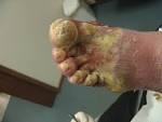 <b>infection</b> including nausea