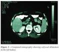of pulmonary <b>tuberculosis</b>.