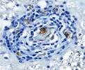 Perivascular <b>infiltration</b> by www.sciencedirect.com