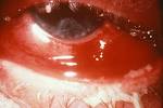 File:<b>Conjunctivitis</b> 5174.jpg