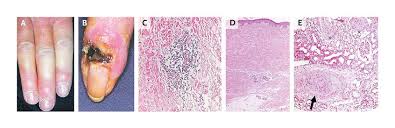 Attēlu rezultāti vaicājumam “Scleroderma”