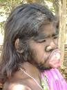 Girl with genetic disorder before surgery | NowPublic Photo Archives