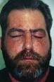 Allergic Reactions