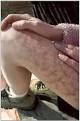 Skin <b>Parasites</b> Association