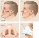 NEPALI HARAMI CHIKAI - rhinoplasty