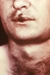 <b>Syphilis</b>