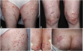 Attēlu rezultāti vaicājumam “Diderma simplex”