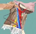 Lateral Pharyngeal and Prevertebral Regions