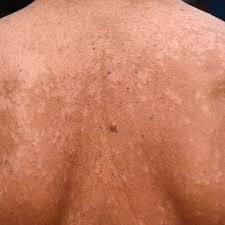 Image result for tinea corporis