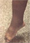 <b>equinus deformity</b> of the