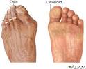 Callosidades y callos