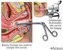Colposcopy-directed biopsy -