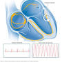 search Ventricular tachycardia from www.mayoclinic.org