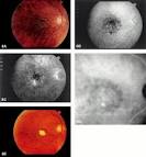 Retinal <b>choroidal</b> anastomoses